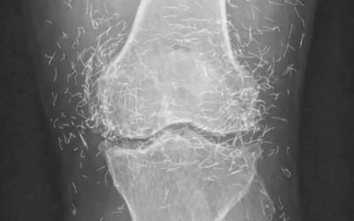Va in ospedale per un dolore al ginocchio: la radiografia lascia tutti a bocca aperta (1 / 2)