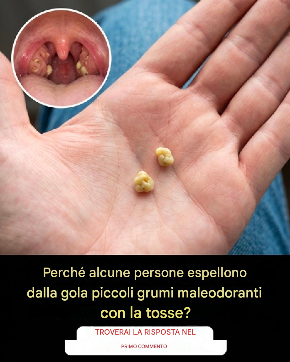 Un nodulo biancastro, un odore sgradevole… Potrebbero essere calcoli tonsillari, responsabili dell’alito cattivo persistente, un problema facilmente prevenibile.