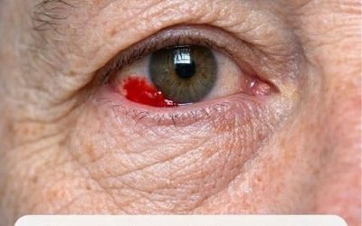Mio marito, di 64 anni, si è svegliato con una macchia rossa e sanguinante sull’occhio. Dovremmo andare in ospedale?
