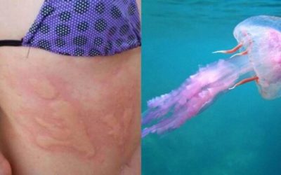 Cosa fare quando ti punge una medusa: i miti da sfatare e la medicazione corretta