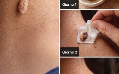 3 rimedi casalinghi per eliminare i badge cutanei – Rimozione dei badge cutanei
