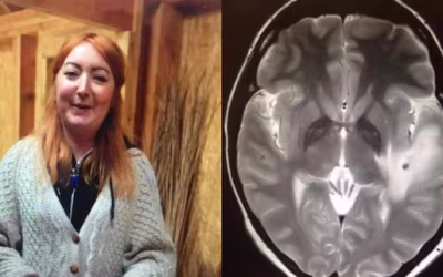 Donna gallese torna dall’India con 38 parassiti nel cervello: il caso della neurocisticercosi