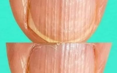 Avere unghie a righe potrebbe significare che il tuo corpo è… Maggiori dettagli qui sotto