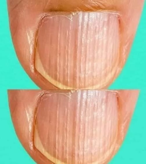 Avere unghie a righe potrebbe significare che il tuo corpo è… Maggiori dettagli qui sotto