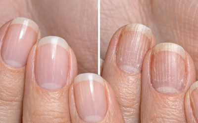 Applica questa soluzione sulle unghie ed elimina sfaldamenti, screpolature e striature ruvide.